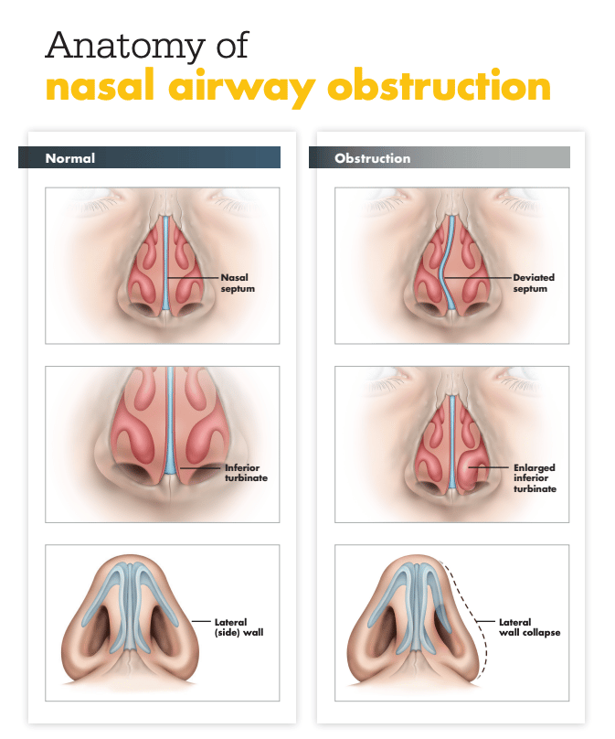 Nasal Airway Obstruction