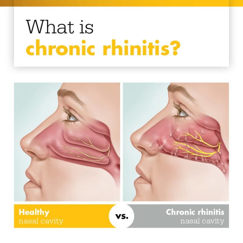 Chronic Rhinitis