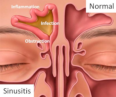 Sinusitis Picture
